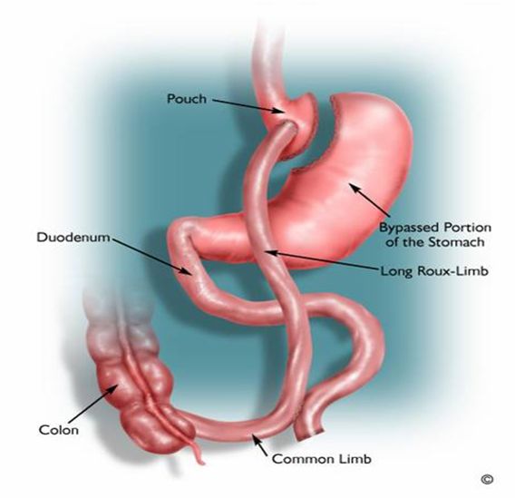 Gastric Bypass Anatomy Images
